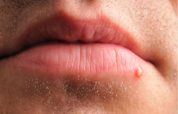 Causes and Prevention of Pimples on the Lip