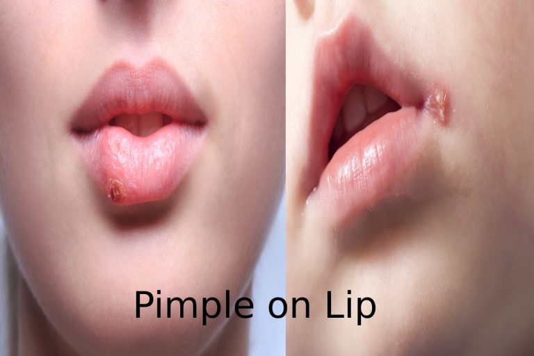 Pimple on Lip – Explanation, Causes, Treatment, And More