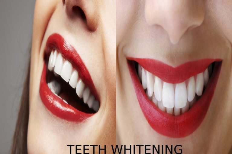 Teeth Whitening – Definition, Causes, Ways, Home Remedies, And More