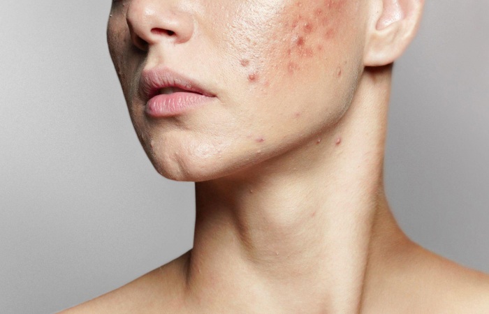 Acne - What Is It_