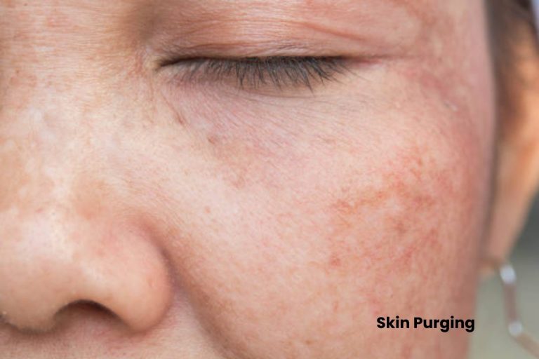 Skin Purging – Use, Work And Mistakes.