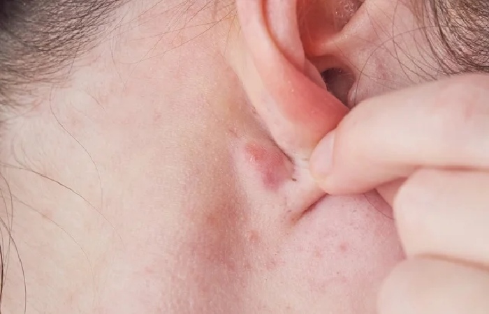 Lump Behind Ear 1